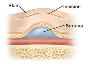 seroma beeld